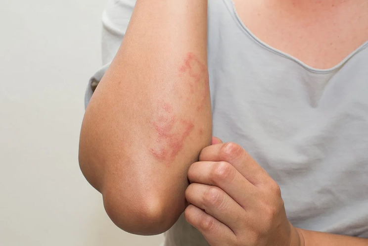 8-things-you-need-to-know-about-monkeypox-6.jpg