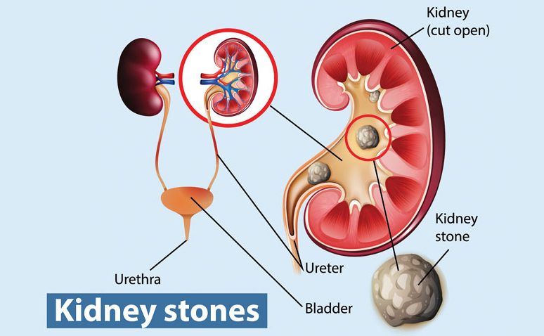 tips-for-building-the-right-diet-to-avoid-kidney-stone-1.jpg