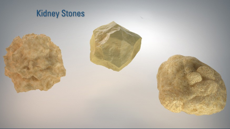 tips-for-building-the-right-diet-to-avoid-kidney-stone-2.jpg